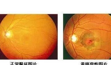 家有老人请注意 黄斑不是病,黄斑病变才是病 不可忽视