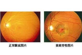 眼睛黄斑病变怎么办