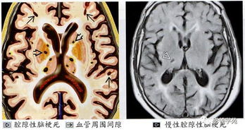 正确解读磁共振脑白质区内斑点影