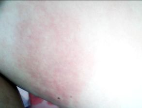 高分 不知被什么咬了,大腿红肿一大片 又痒又疼 谁能告诉我该怎么办