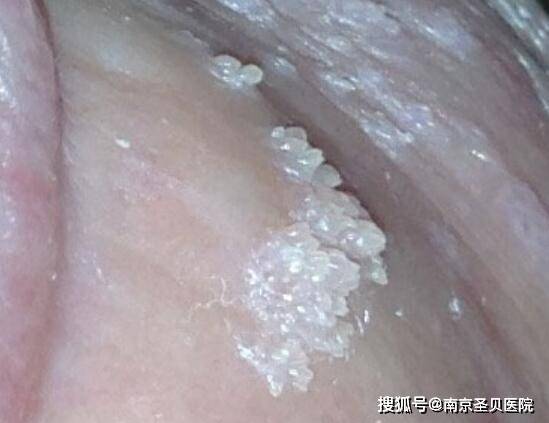 营养土上面变白;营养土有白色的霉斑