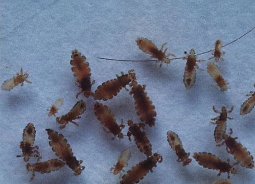 20多年前农村的虱子泛滥,为何现在却都不见了 看完懂了