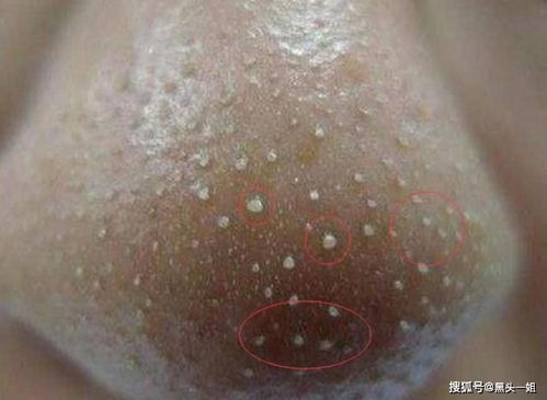眼角下 鼻子旁的小白颗粒是什么呀 毛周角化 鸡皮肤