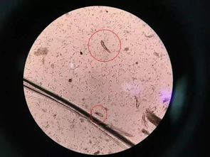 螨虫痘 真的是螨虫导致的