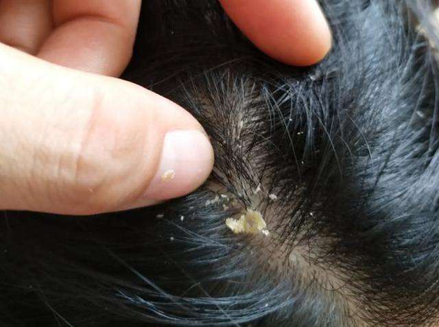 头上抠下一指甲 白泥 ,又油又臭怎么回事 医生 与一原因相关