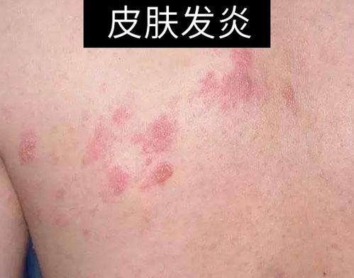 怎么判断脸上有螨虫被螨虫咬了 脸上挤出硬粒是螨虫吗