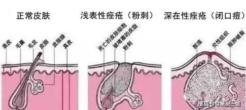 下巴上长的一颗一颗的小白点是什么 有些还能挤出白色的油脂,是闭口吗