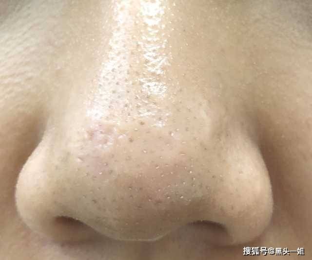 下巴上长的一颗一颗的小白点是什么 有些还能挤出白色的油脂,是闭口吗