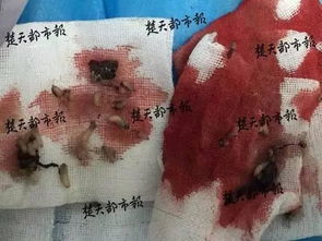 男子头生出50条虫 女孩诊为败血症 竟是因挤痘