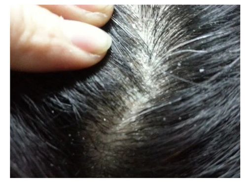 美业赵勤 头皮屑没完没了,我们该怎么办